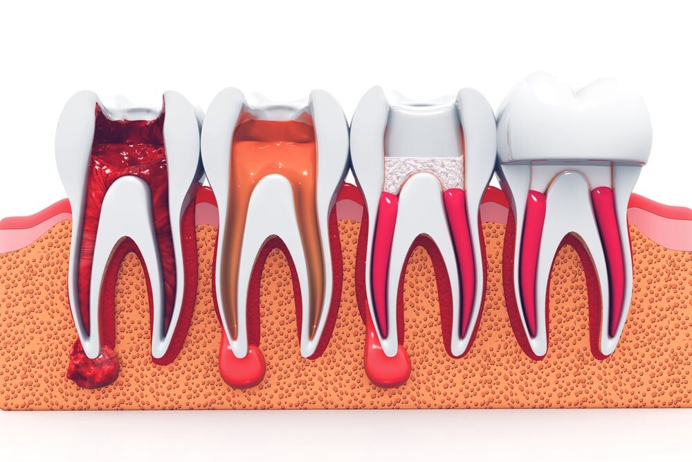 Stages of Root Canal Therapy