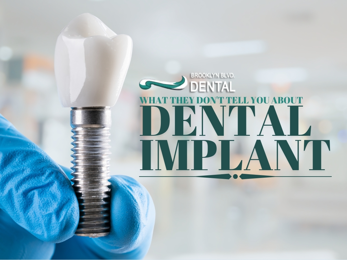 What They Don't Tell You About Dental Implants