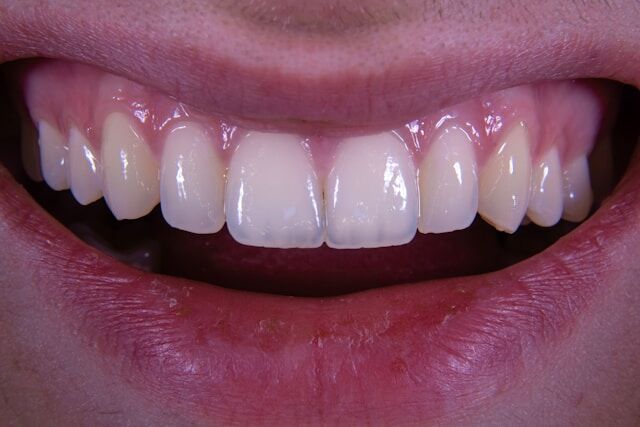 CEREC Crown